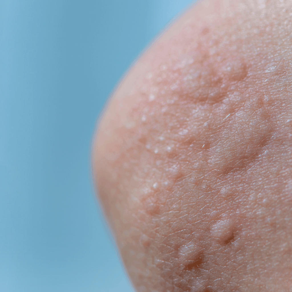 anaphylaxis nclex prep review