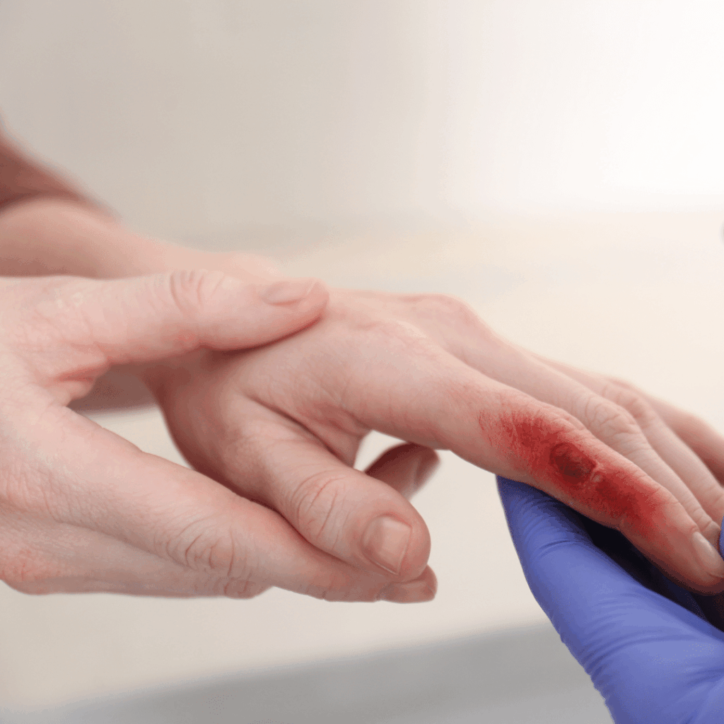 nclex review for burn injuries