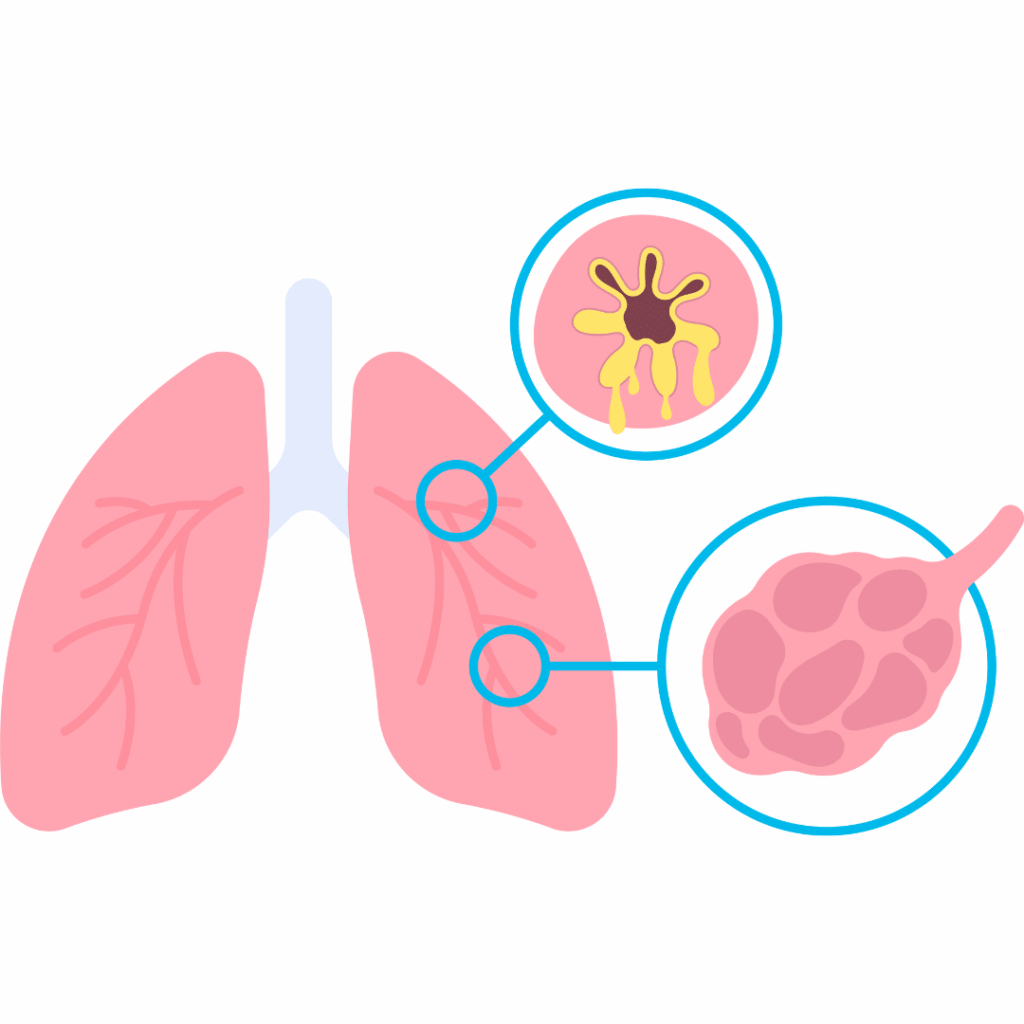 COPD (Chronic Obstructive Pulmonary Disease) nclex prep