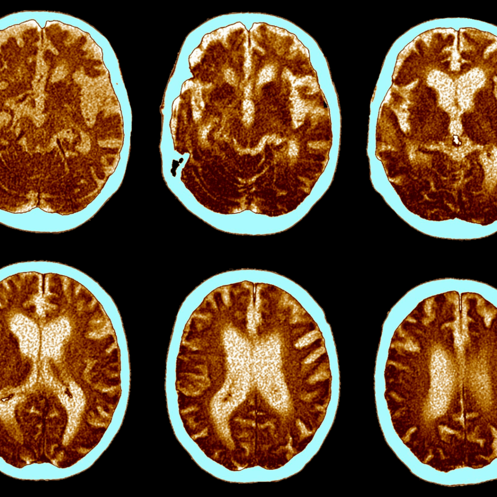 Cognitive Impairment Disorders nclex prep