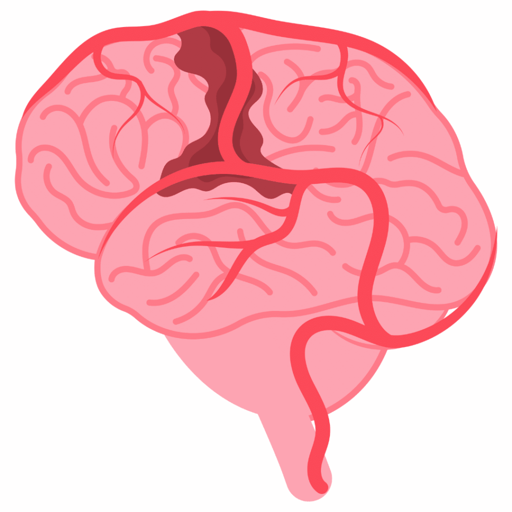 nclex prep stroke