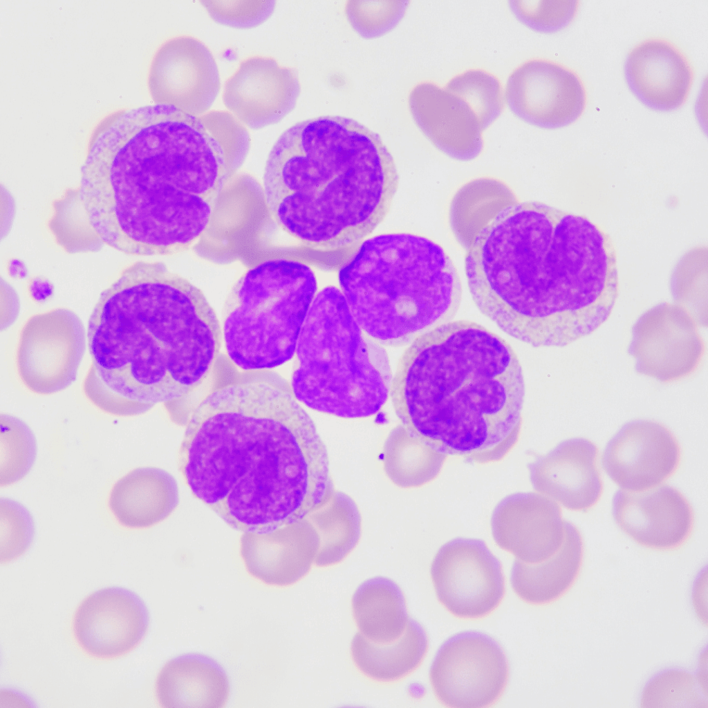leukemia nclex prep review