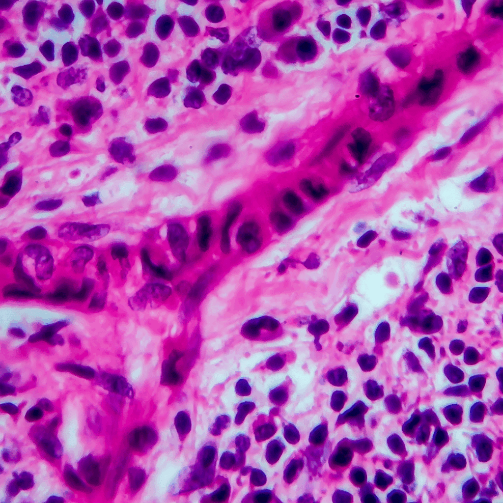 lymphoma nclex review for nursing students