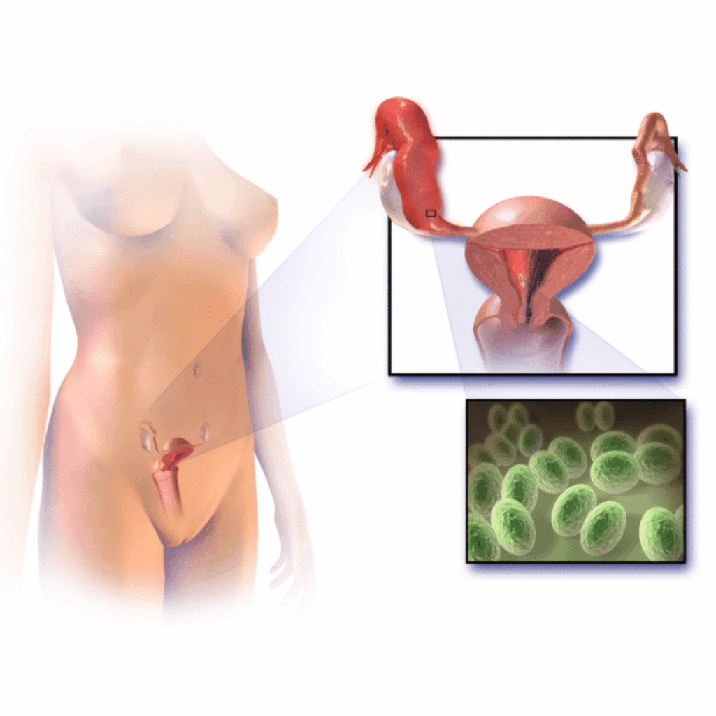 pelvic inflammatory nclex prep review