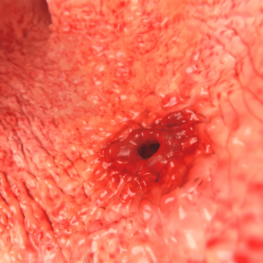 nclex prep for peptic ulcer disease
