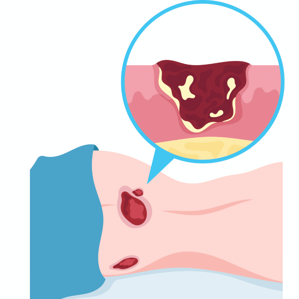 nclex prep review for pressure ulcers