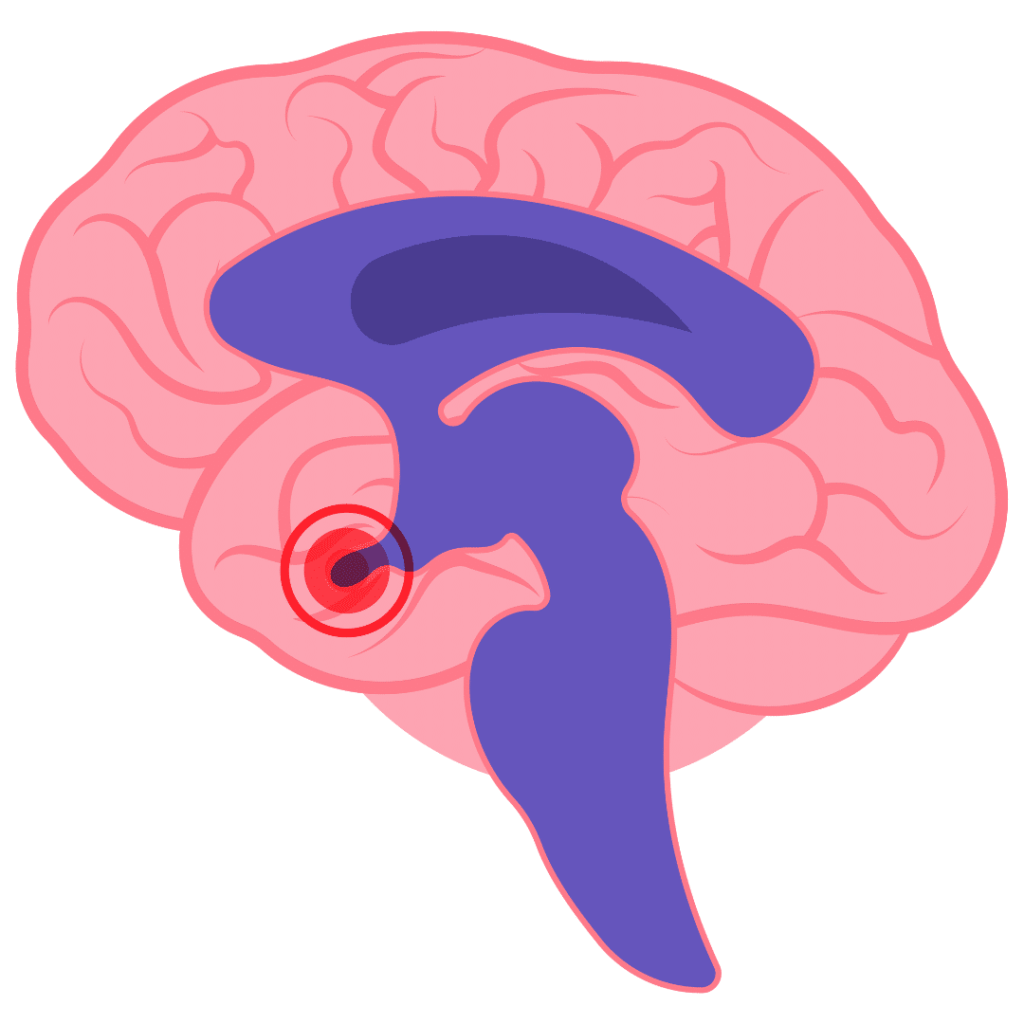 SIADH (syndrome of inappropriate antidiuretic hormone secretion) NCLEX prep