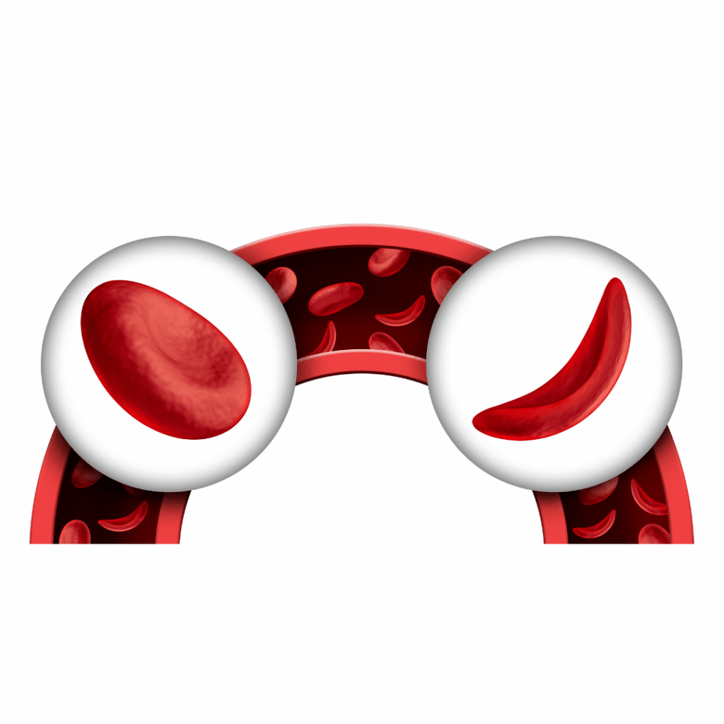 sickle cell anemia nclex prep review