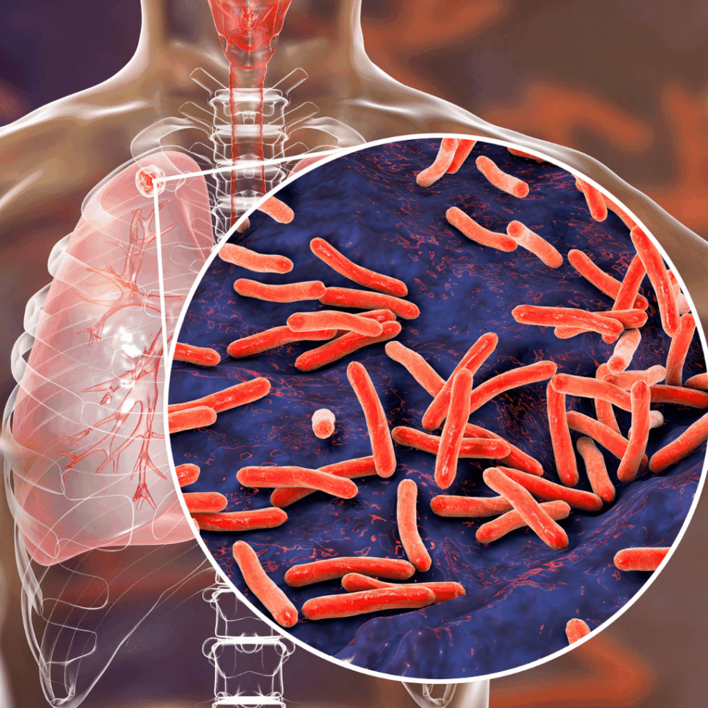 nclex prep Tuberculosis (TB)