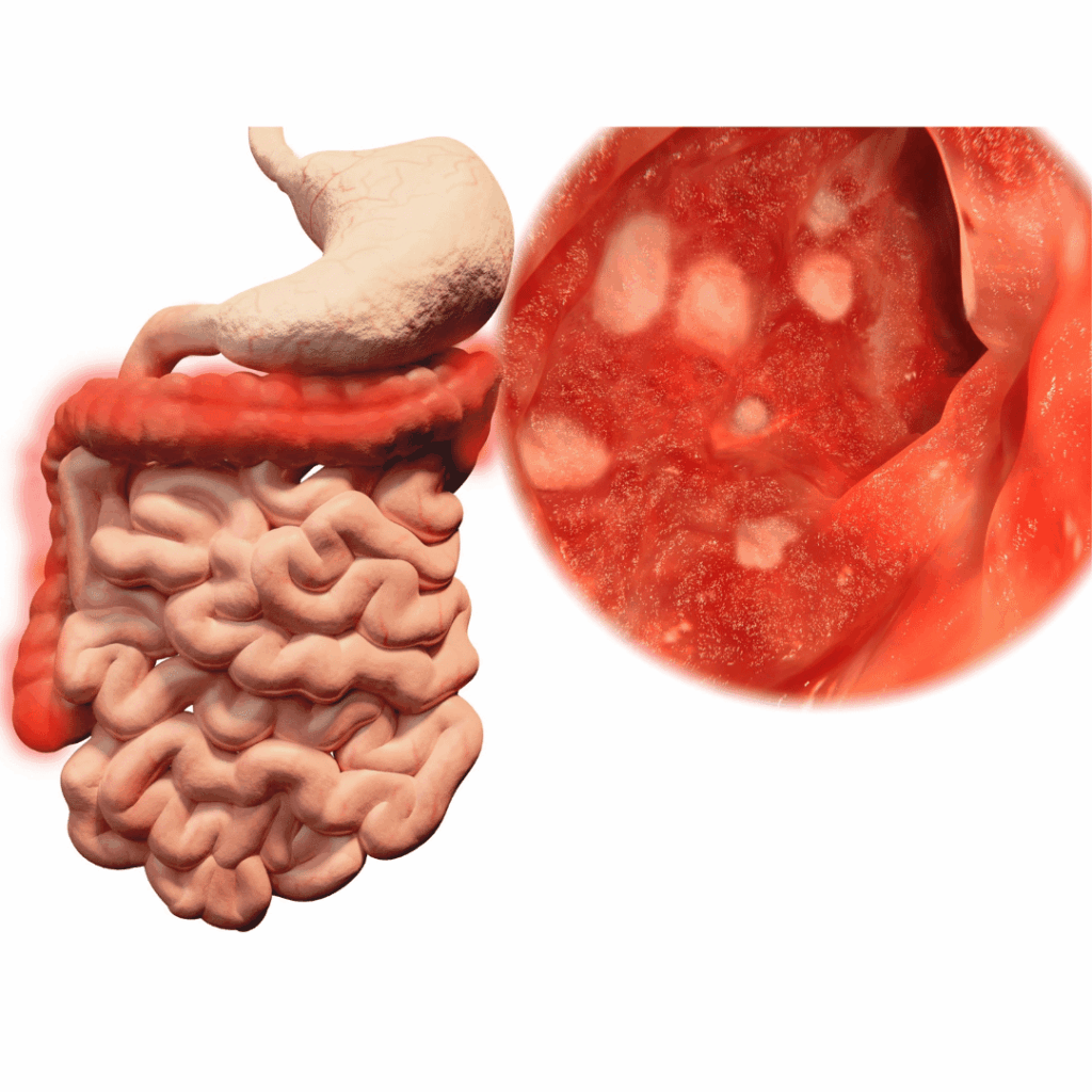 nclex prep for ulcerative colitis