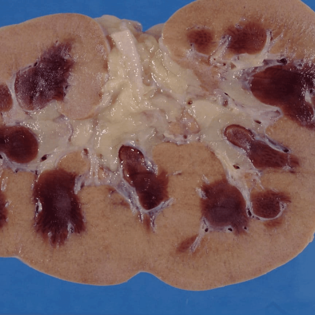 acute kidney injury nclex prep review